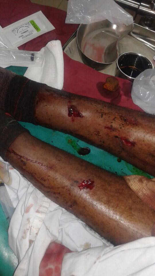 Mr Delmar is at Chitungwiza Hospital seeking treatment as they butchered his legs with pangas .
